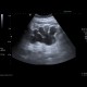 Hydronephrosis, end-stage: US - Ultrasound